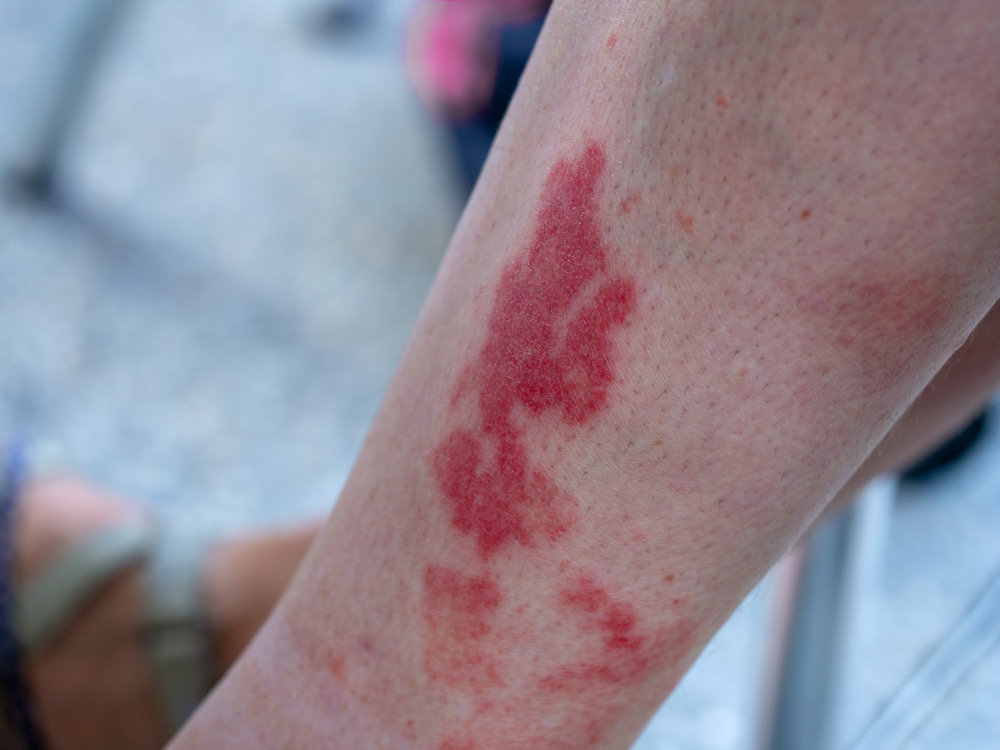 close up view of the disney rash on a leg